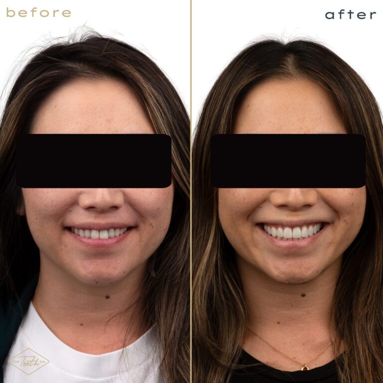 Before and after smile transformation on a woman, cosmetic dentistry in Irvine, CA