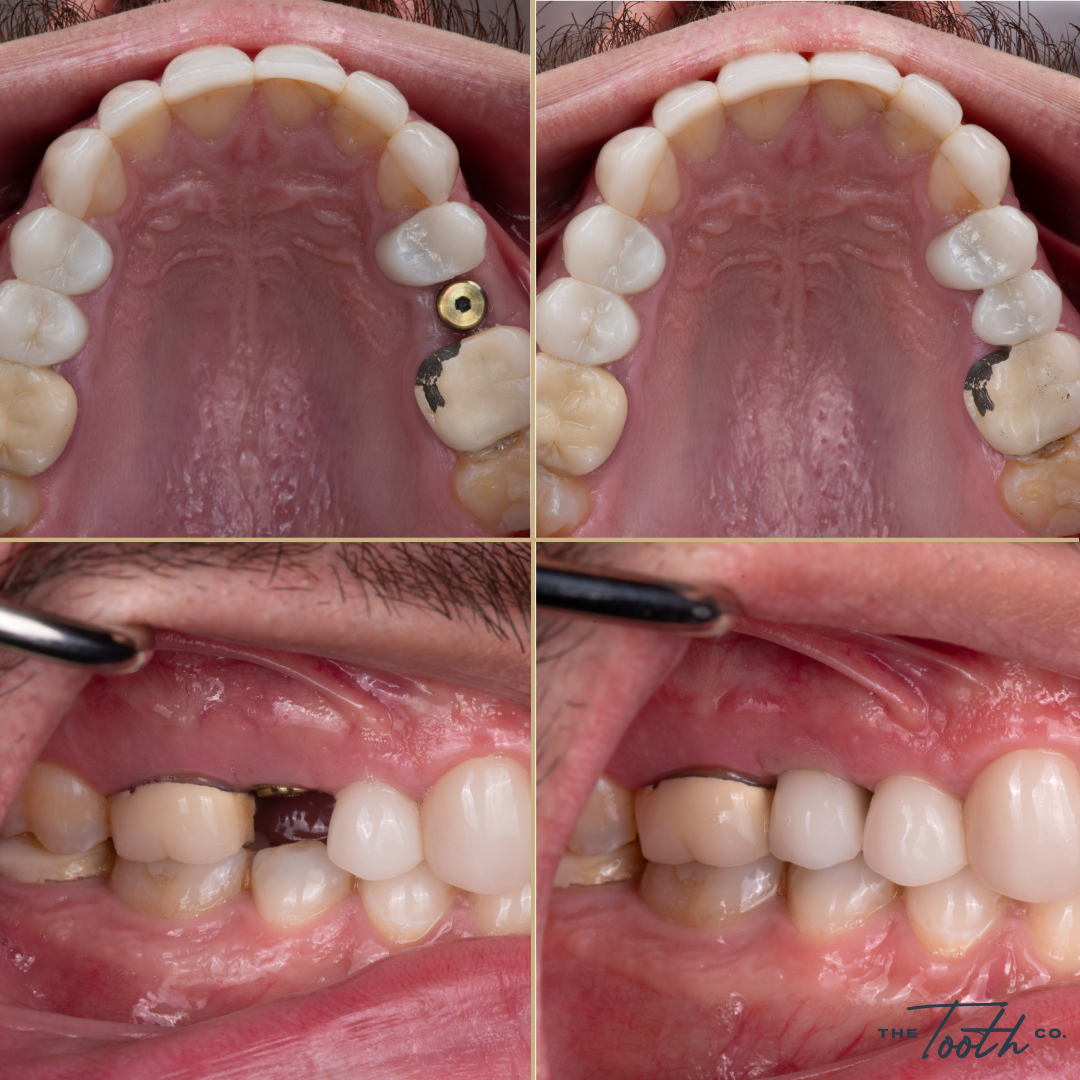 Single dental implant before and after at The Tooth Co. in Irvine, CA